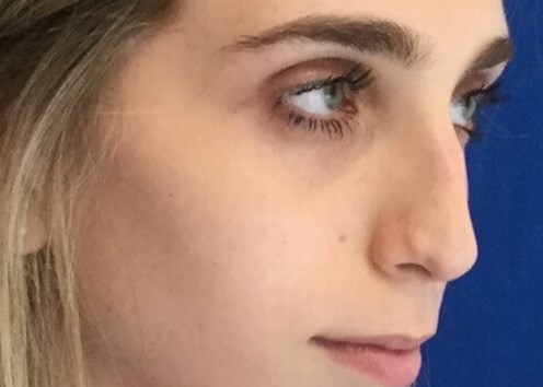 Before Rhinoplasty with Dr. Su